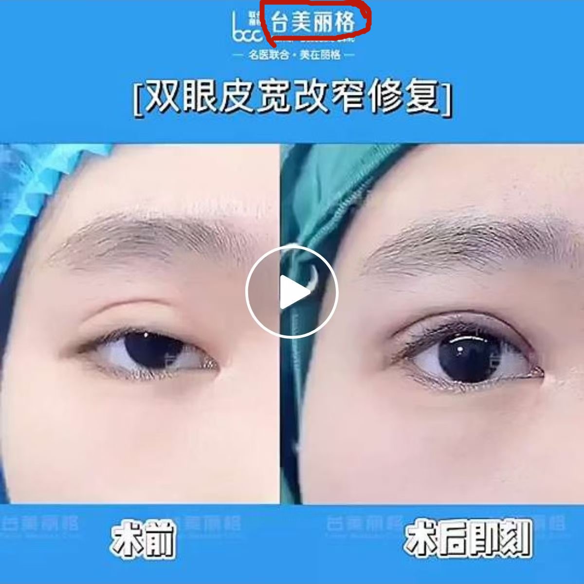 单眼上睑下垂修复术,上睑下垂眼睛修复手术成功率高吗