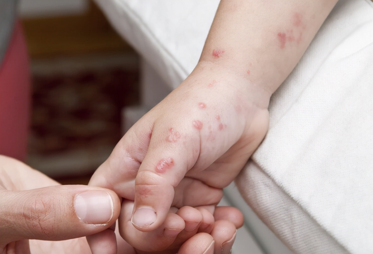 错把艾滋病当皮肤病,别错把艾滋当成皮肤病