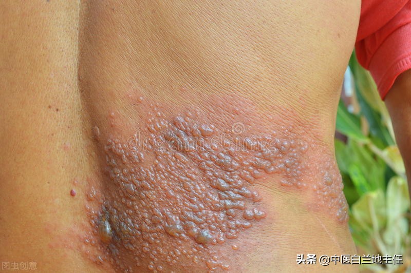 「病例分享」中医辨证施治7副Y解决带状疱疹