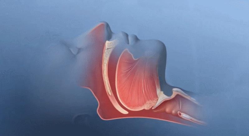 睡眠呼吸机工作原理动画演示,睡眠呼吸机治疗打鼾的原理