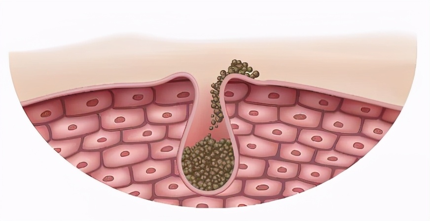 热天非常热然后长了痘痘是什么痘,夏天长痘怎么办教你轻松赶跑痘痘
