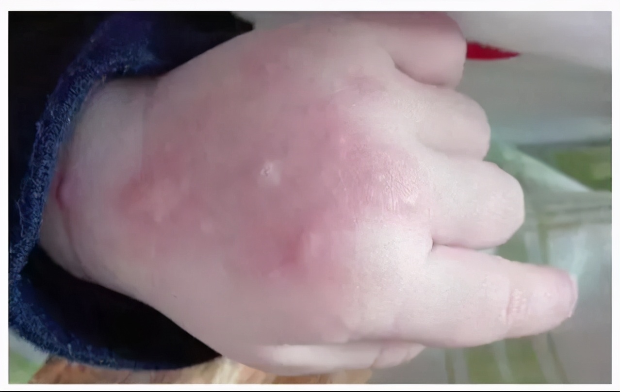 夏季避免宝宝蚊虫叮咬,夏天怎么预防蚊虫对宝宝的叮咬