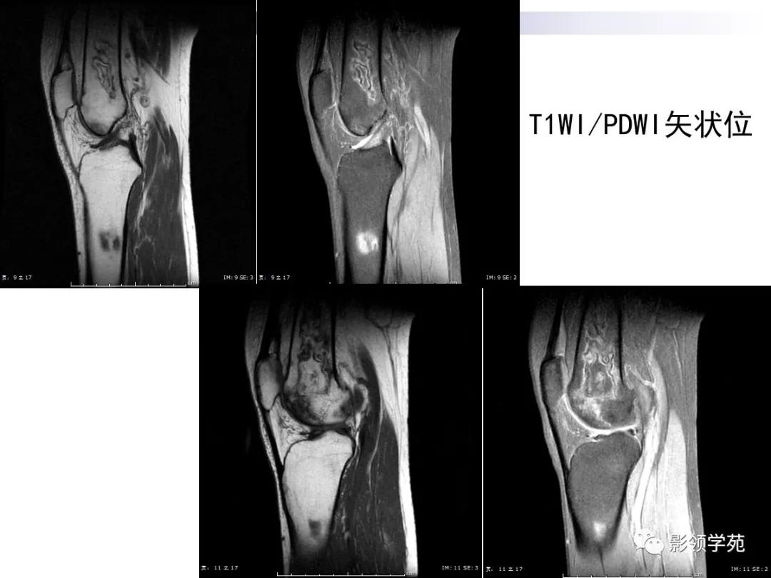 早期骨梗死的ct表现,骨梗死的病理变化