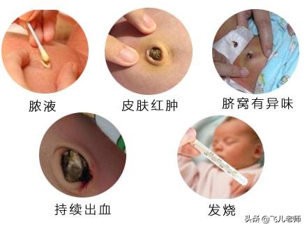 新生儿脐带一个月了还不掉怎么办,新生儿脐带一个多月未脱落