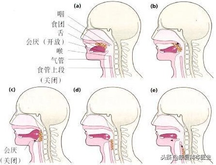 中风后吞咽困难治疗药物,中风后吞咽障碍多久可以恢复