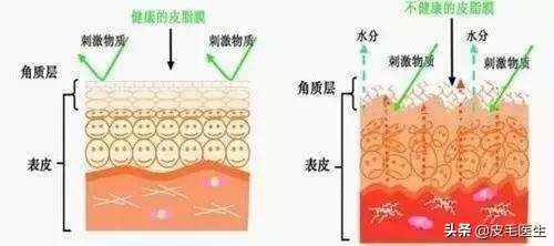 皮肤换季爆痘怎么办,皮肤换季干燥敏感爆痘怎么办