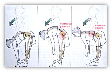 腰痛反反复复难治愈,终于找到腰痛发作的元凶