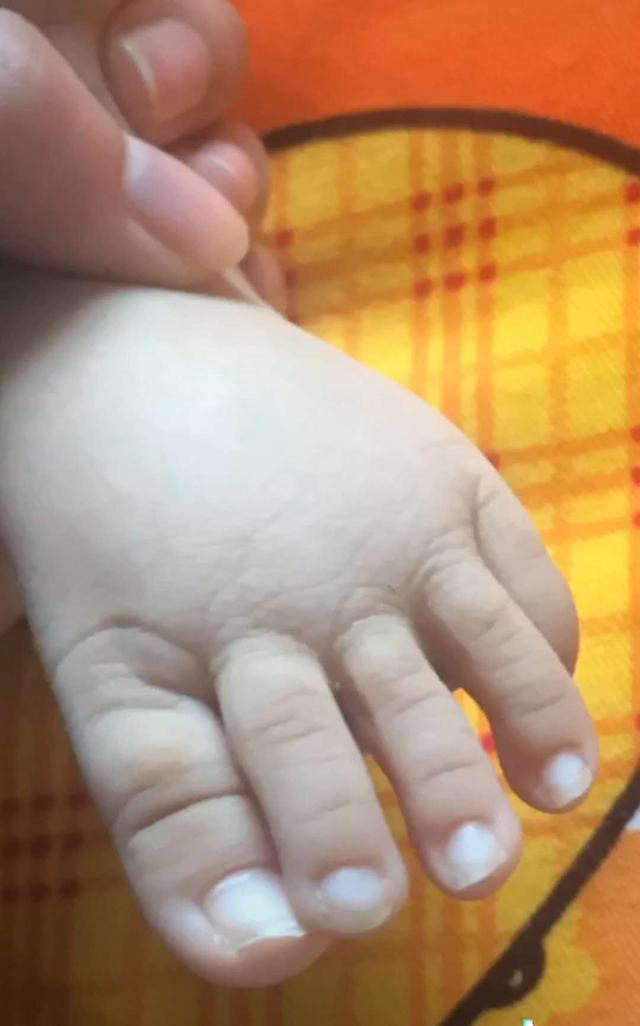 宝宝脚趾长怎么办,宝宝多长了一个小脚趾怎么办