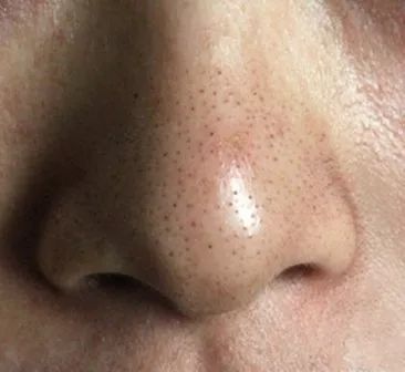 油皮面部清洁去黑头,油皮护肤去黑头闭口