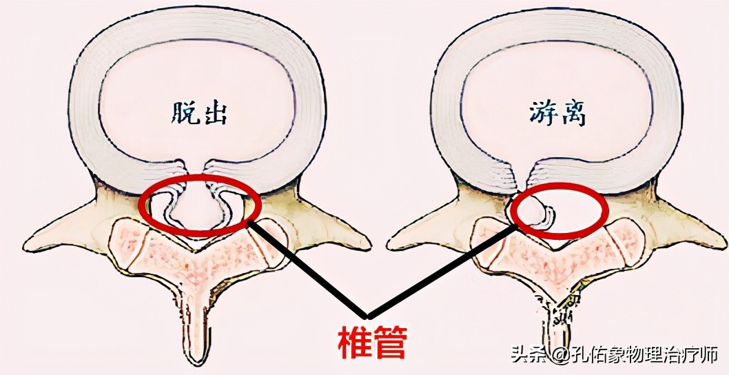 腰椎管狭窄引起的腰腿疼怎么办,腰椎管狭窄引起腰痛腿痛怎么办