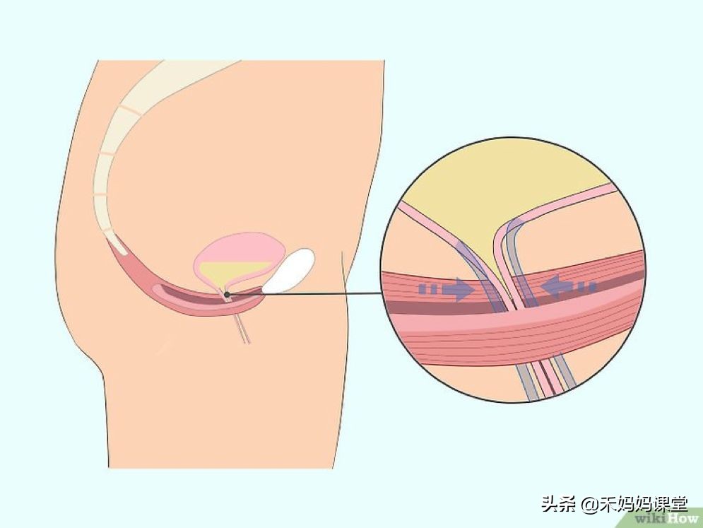 咳嗽喷嚏大笑后漏尿正常么,开合跳咳嗽打喷嚏就漏尿怎么改善
