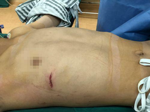 漏斗胸的治疗最好方法,漏斗胸保守治疗方法