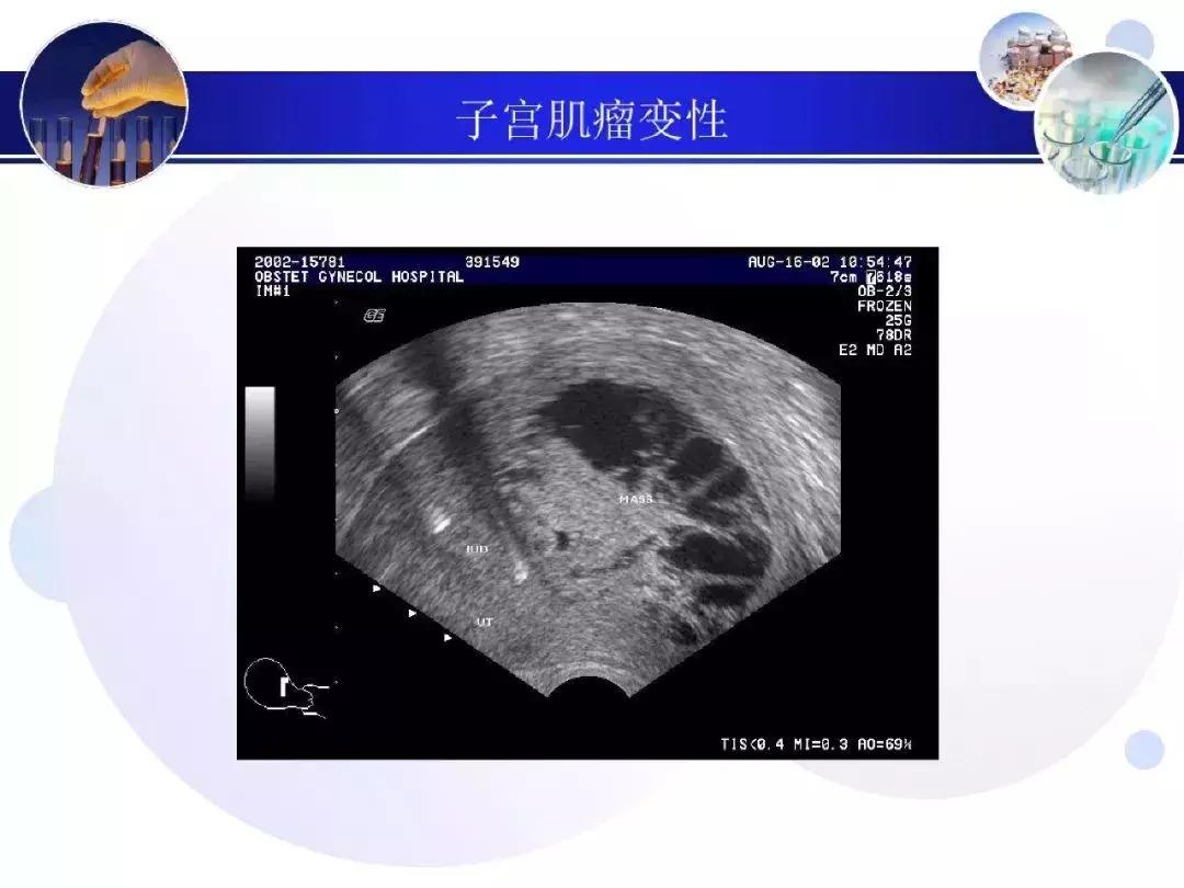 纯干货！子宫及附件解剖和超声诊断