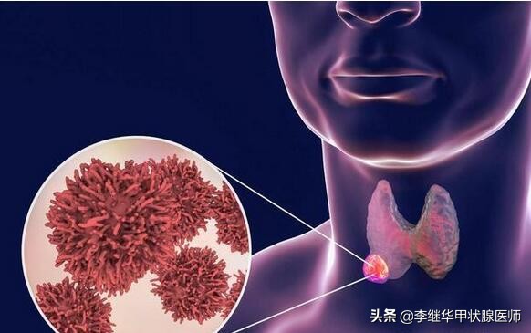 甲状腺结节良恶性鉴别方法,甲状腺结节恶性5类严重吗