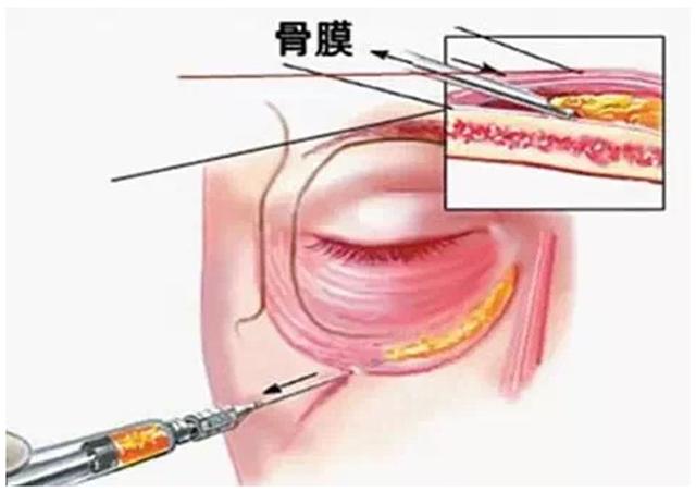 关于泪沟告诉你三个绝招,新手好上手的遮泪沟方法