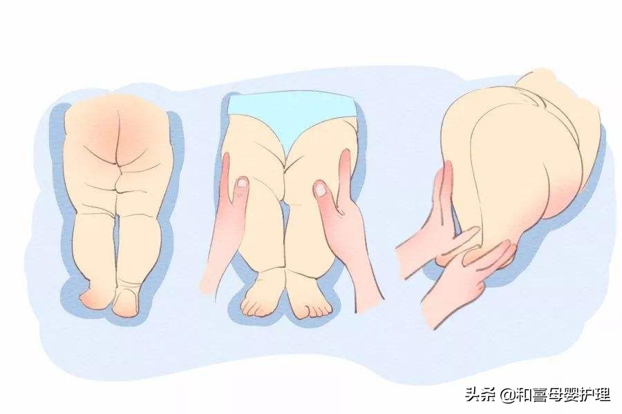 宝宝臀纹不对称是腿部畸形吗,宝宝臀纹不对称腿纹对称