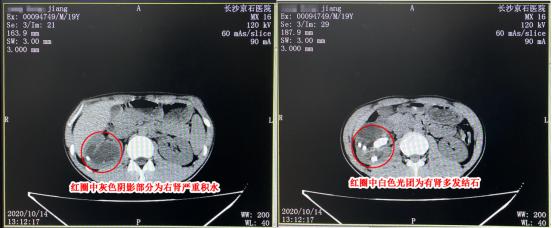 21岁小伙结石,19岁男生得肾结石的记录