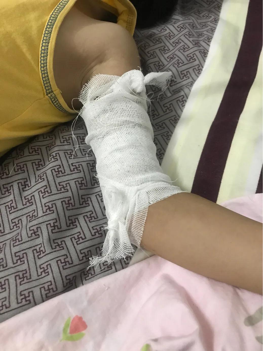 当女儿被严重烫伤疼痛难忍,幼儿园女孩被烫伤治疗过程