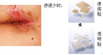 压疮液体敷料怎么用,压疮的治疗首选敷料