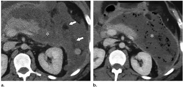 急性胰腺炎影像检查首选,急性坏死胰腺炎影像