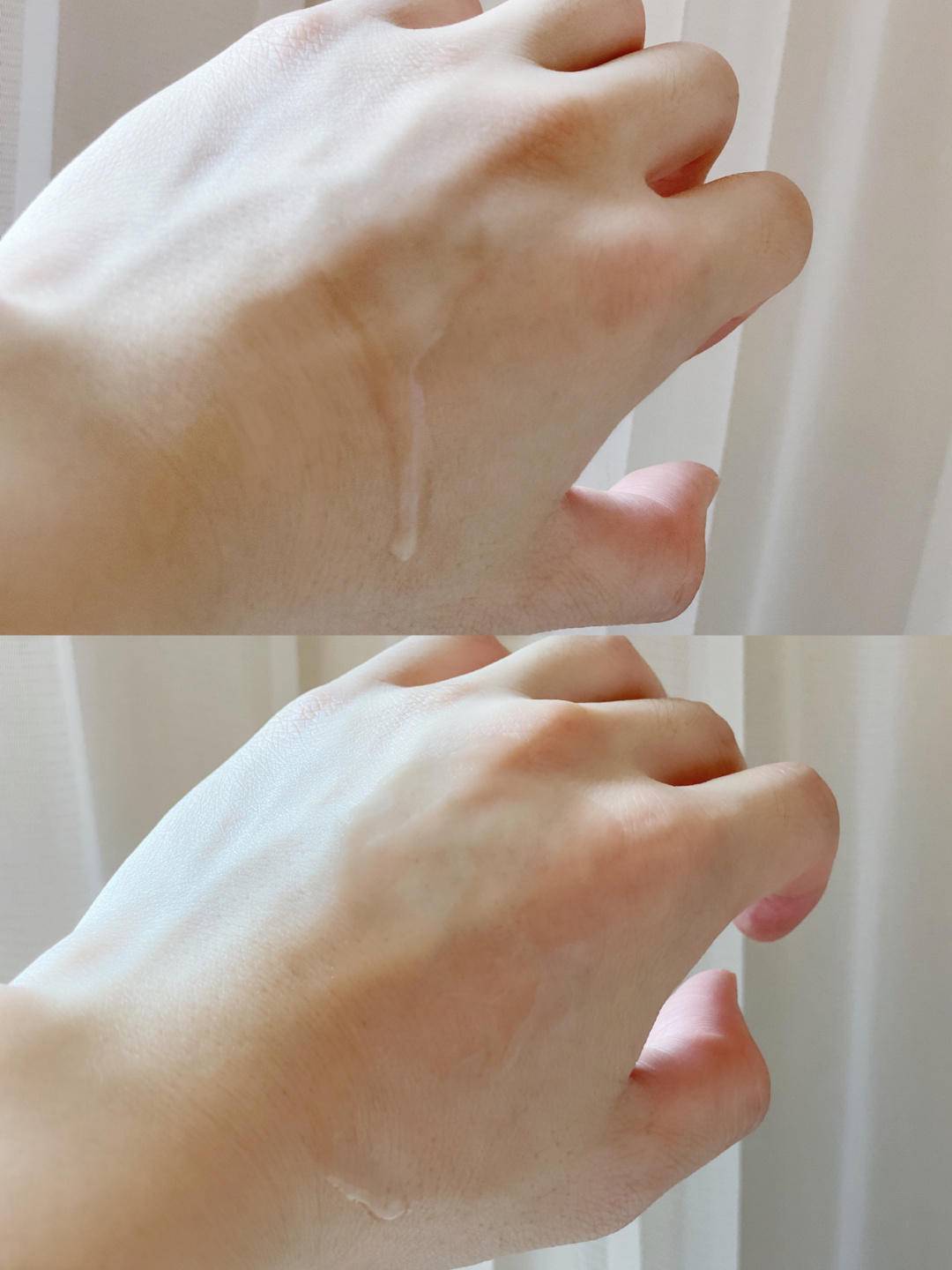 眼周水肿的原因分析,如何改善眼皮浮肿