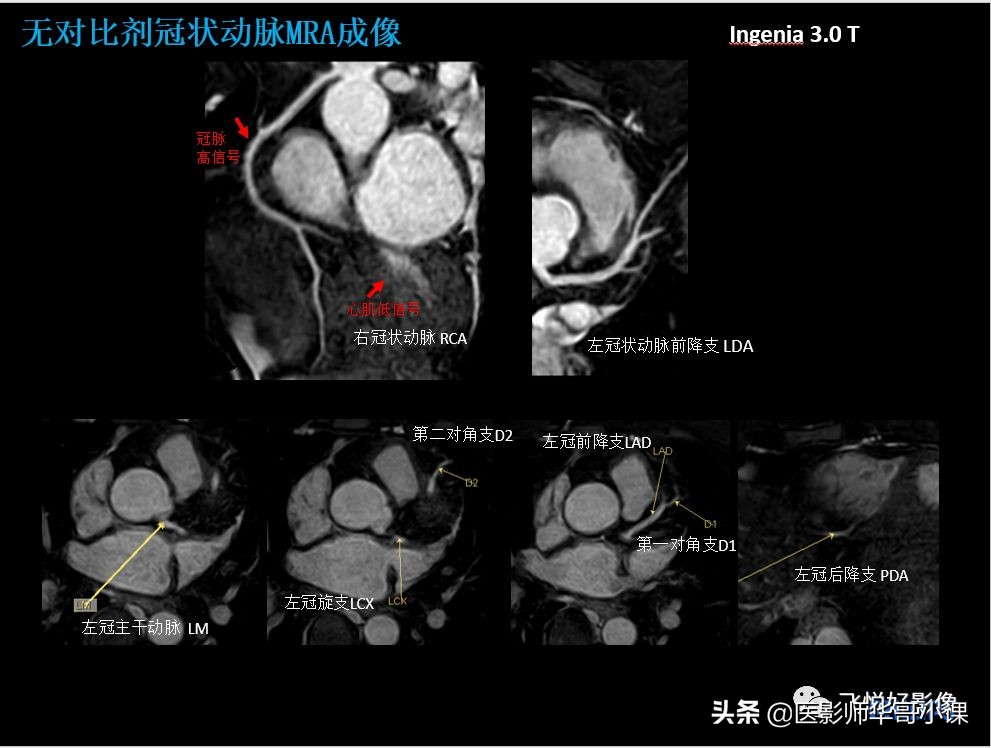 飞利浦核磁共振快速扫描,飞利浦磁共振心脏扫描