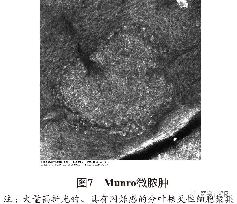 炎症性皮肤病反射式共聚焦显微镜诊断特征专家共识全文发布