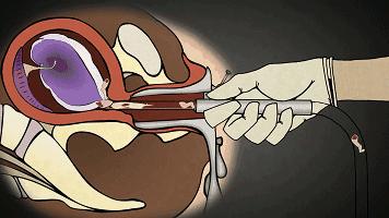 人流和药流哪个更伤身体,孕囊8mm药流伤身吗