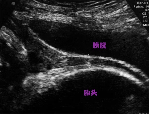 超声检查膀胱没事还要做膀胱镜吗,做彩超憋尿对膀胱有危害吗