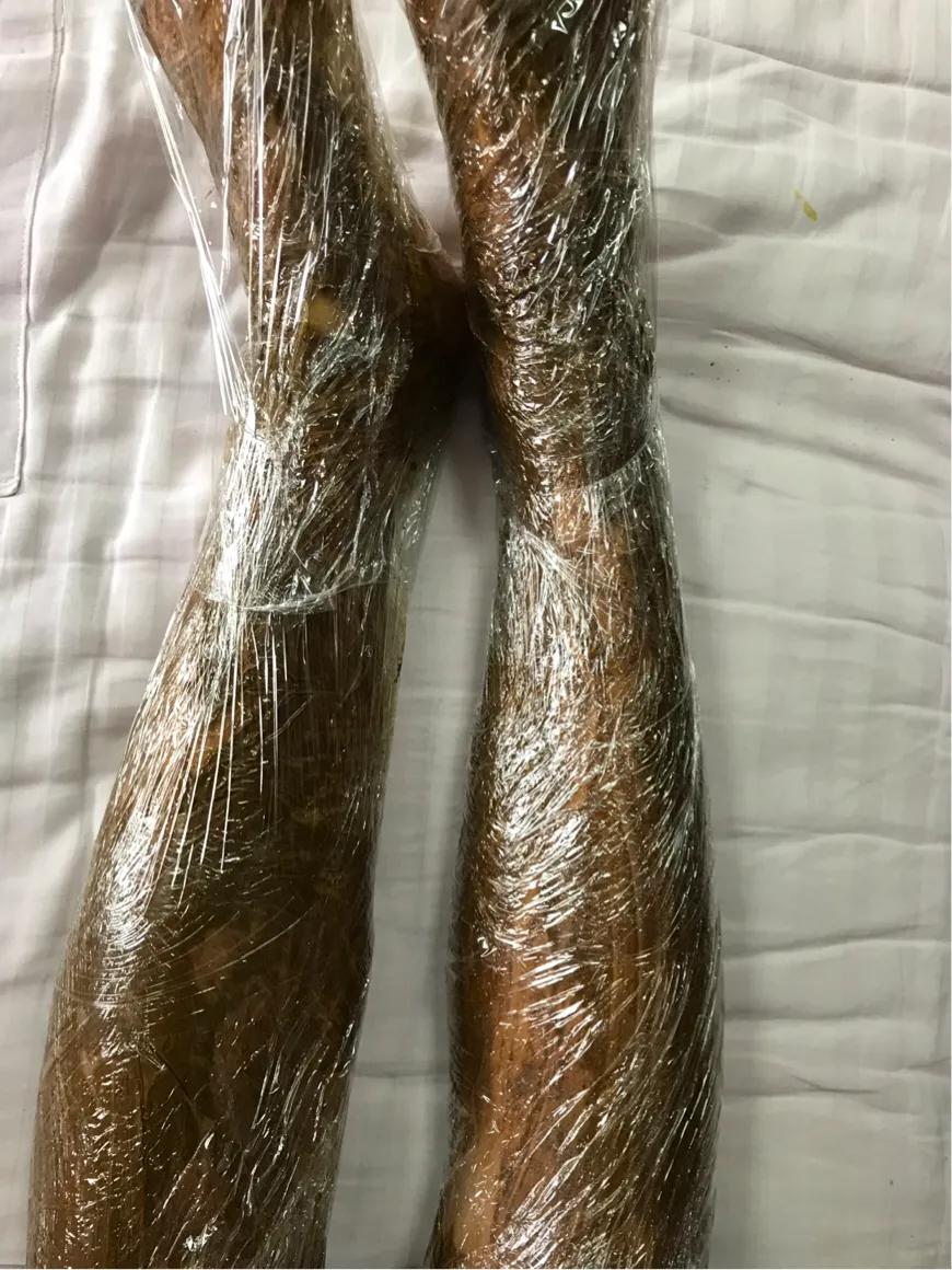 过敏性紫癜的鉴别图片,过敏性紫癜反复出零星小点