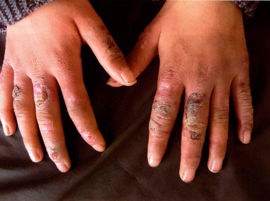 一到冬天就复发?小菌衣教你几招远离冻疮烦恼