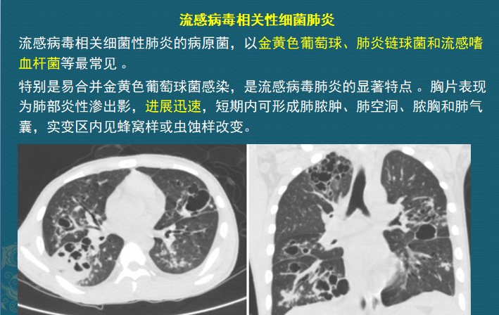 流感合并细菌感染时有什么症状,流感合并细菌感染可以治好吗