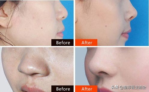 为什么有人鼻子不好看,为什么很多人鼻子不好看也很漂亮