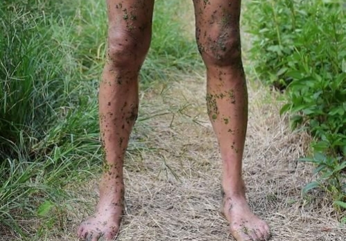 水蛭钻进身体里能活吗,水蛭被人吃进肚子里它能活多久