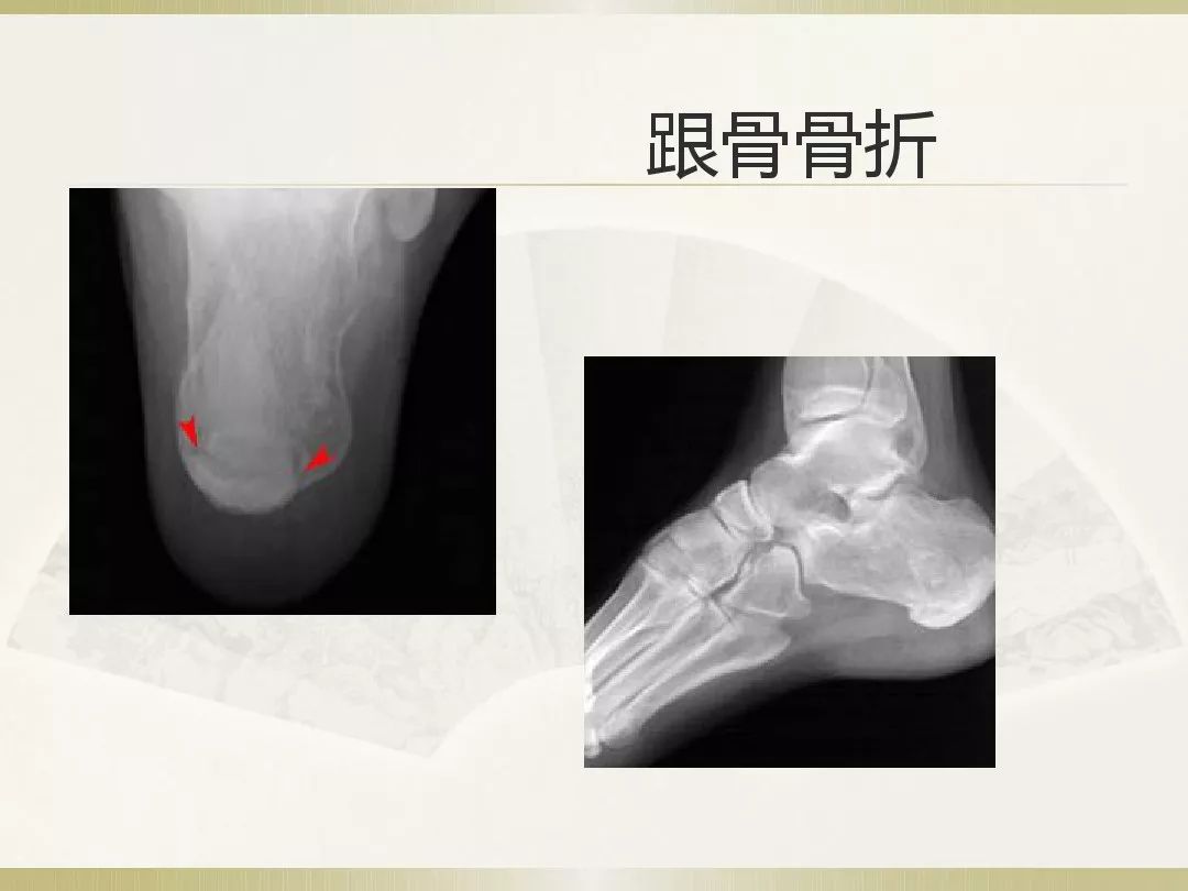 骨科x光片读片技巧,放射科骨科读片教程