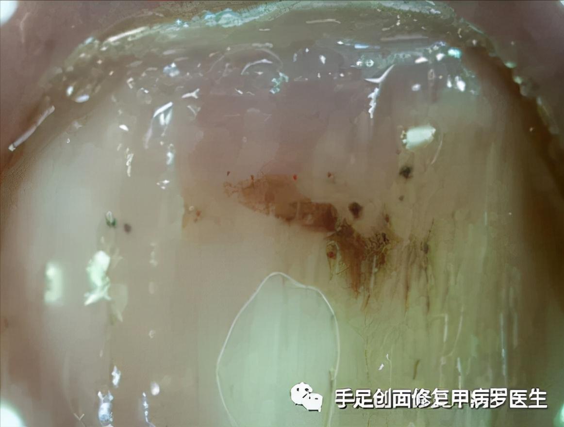 甲下积血怎么处理,甲下积血不排血会胀痛吗