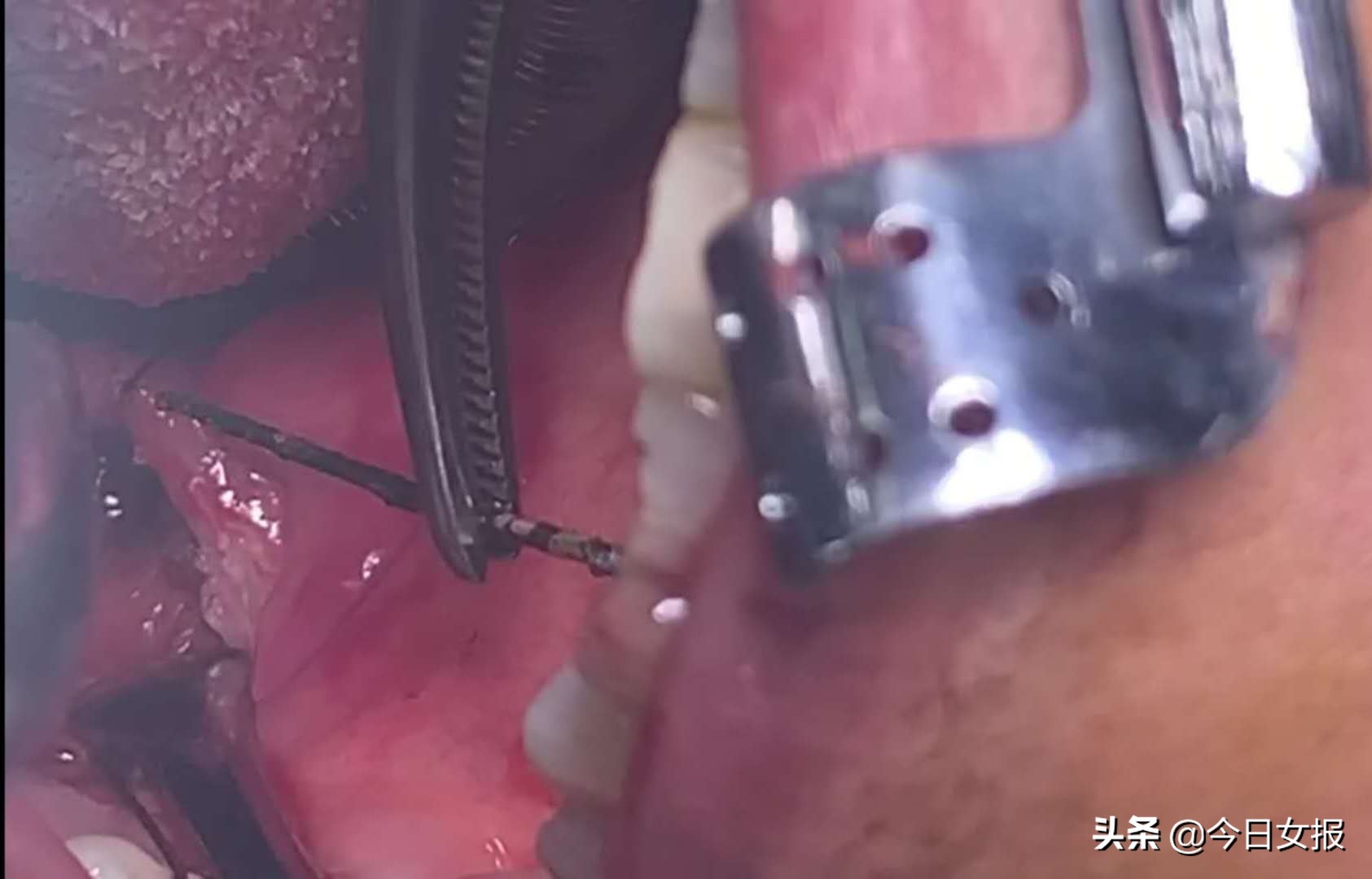 六旬老人喝汤吞下钢针分两次才取出！汤里竟藏着洗碗留下的钢丝球