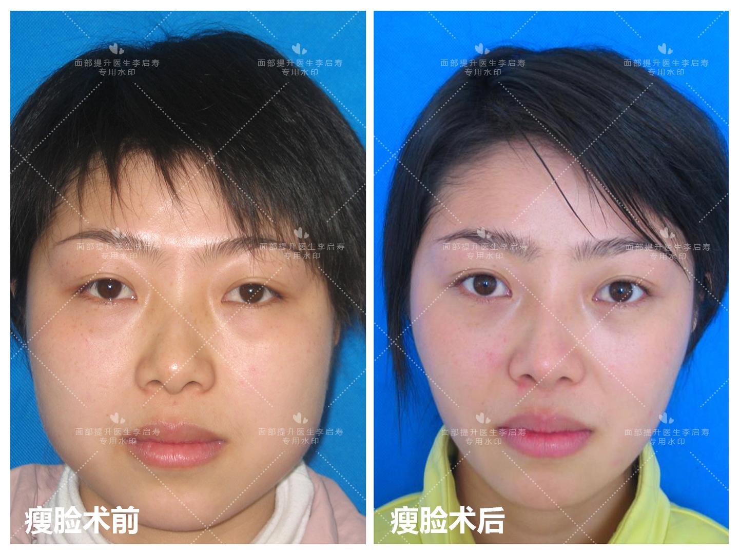 谈谈自己的整形经历,整形过来人经验分享