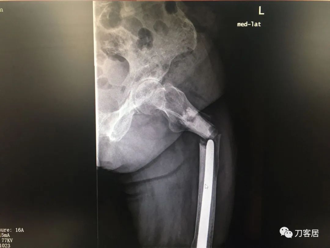 股骨胫骨骨折中医治疗方法,中药治疗股骨颈骨折