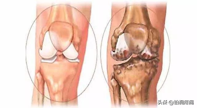 女人膝盖疼痛警惕四种病因,膝盖内侧疼痛的病因