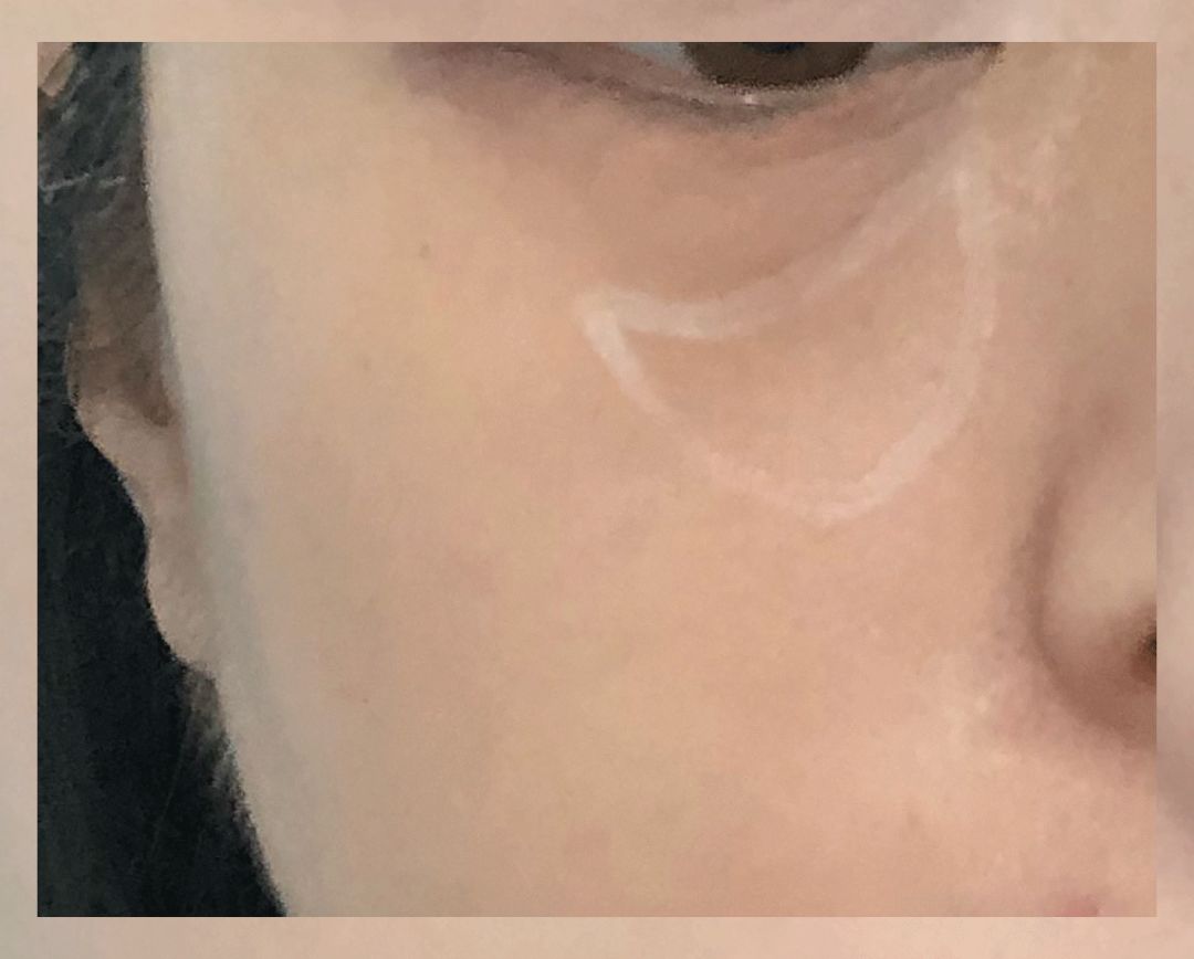 董氏奇穴一针治疗黑眼圈,熊猫针一针就能去掉黑眼圈吗