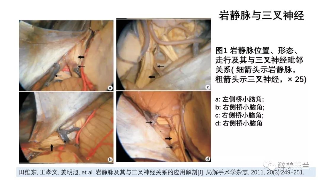 病例分享丨三叉神经节微球囊压迫术的麻醉管理