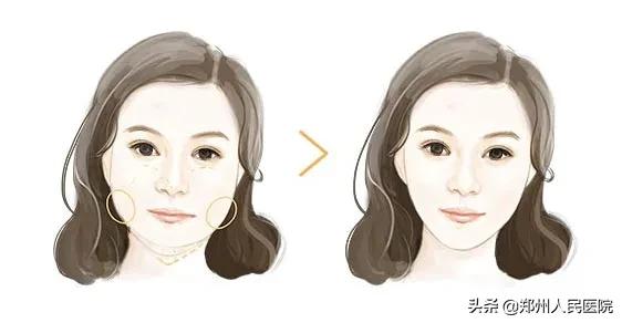 川字纹抬头纹鱼尾纹全脸年轻化,川字纹抬头纹鱼尾纹法令纹去除