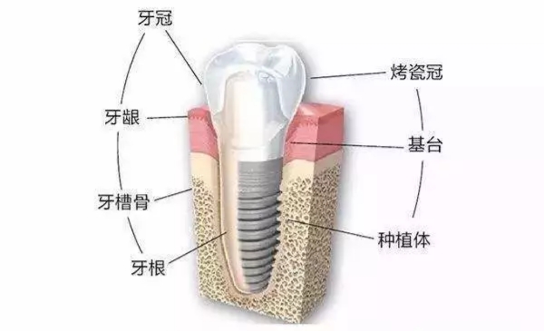 种植牙的知识你知道几个,咨询一下做种植牙全过程