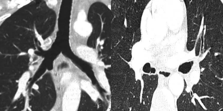 胸腺增生和纵隔肿瘤的区别和症状,纵隔胸腺肿瘤的常见临床症状表现