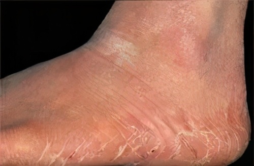 脚气为什么反复发作就是治不好,脚气总是治不好怎么回事