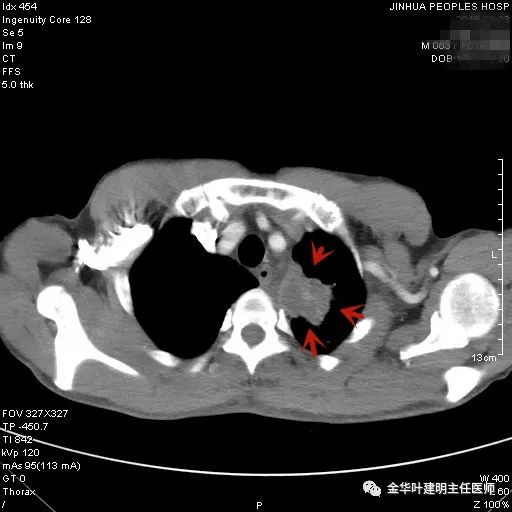 叶建明谈胸膜下的实性结节,叶建明肺实性良性结节会变癌症吗