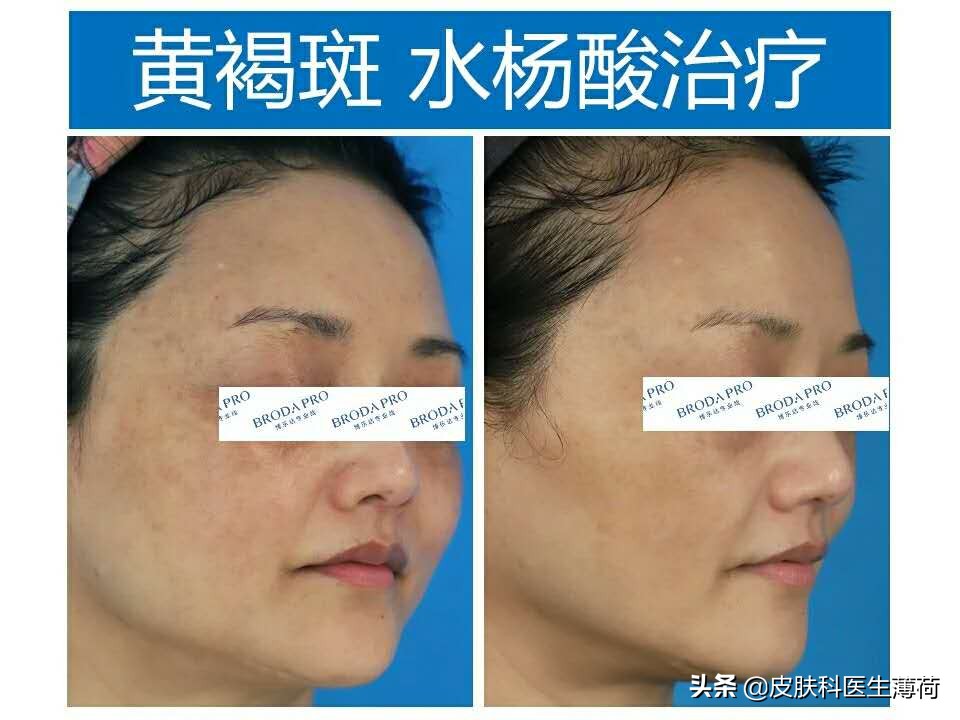 修复痘坑水杨酸果酸哪种好用,刷酸去闭口水杨酸敏感肌