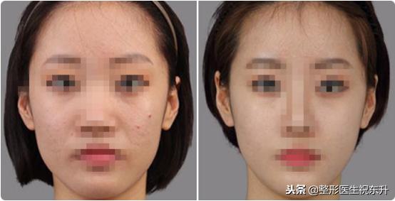 光子嫩肤敏感皮肤能做吗,光子嫩肤做了皮肤敏感