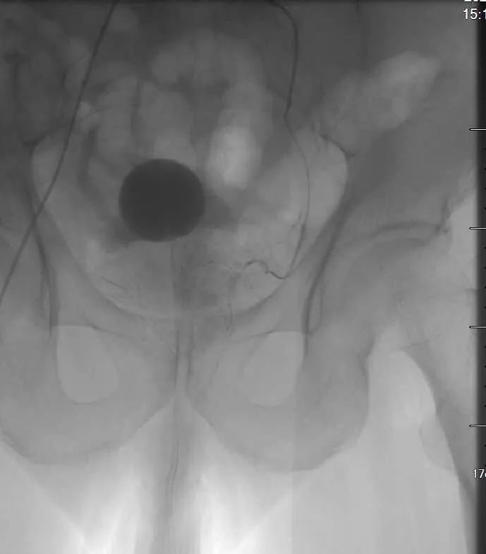 山东大学第二医院前列腺栓塞术,聊城市第二人民医院华美院区